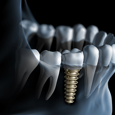 Illustration of an x-ray of a person with a dental implant