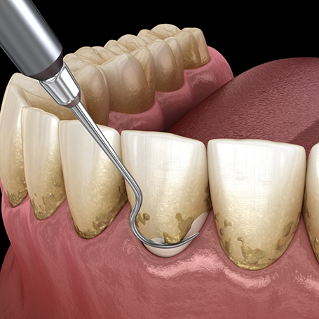 Illustration of a dental scaler performing gum disease treatment in Marietta