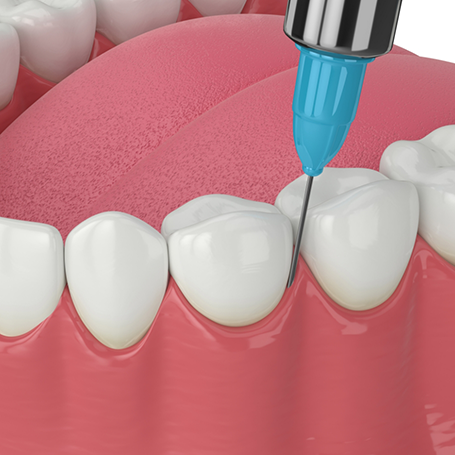 Illustration of a topical antibiotic being applied to the gums