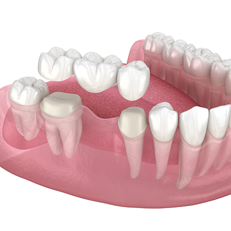 Illustration of a dental bridge replacing a missing tooth