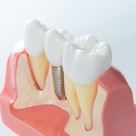 Model of a dental implant between two natural teeth
